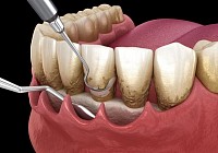 Periodoncia